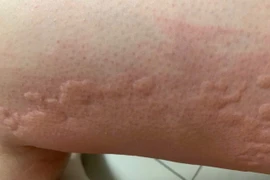 Mày đay cấp bùng phát mùa Tết, đừng chủ quan những mảng đỏ 'nở rộ' trên da