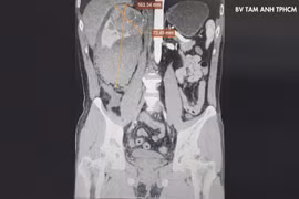 Không khám định kỳ, bất ngờ phải cắt thận vì ung thư vỡ