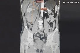 Không khám định kỳ, bất ngờ phải cắt thận vì ung thư vỡ