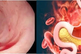 Phân biệt xuất huyết tiêu hóa và bệnh di truyền huyết học