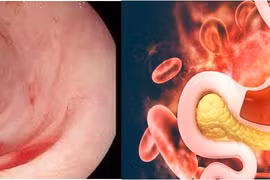 Phân biệt xuất huyết tiêu hóa và bệnh di truyền huyết học