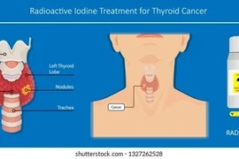 1% ung thư tuyến giáp nguy cơ thấp tử vong