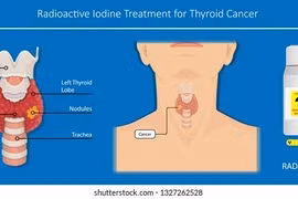1% ung thư tuyến giáp nguy cơ thấp tử vong