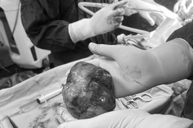 Phẫu thuật thành công u tuyến tiền liệt khổng lồ 600g cho cụ ông 83 tuổi