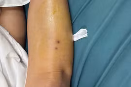 Hôn mê, suy hô hấp sau khi bị rắn cắn vào cẳng chân