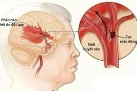Địa chỉ vàng: Bệnh viện cấp cứu bệnh nhân đột quỵ tại Hà Nội