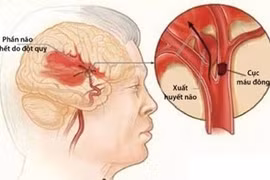 Đột quỵ và “vết sẹo” vô hình trên não bộ
