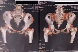 Cứng khớp sau cú ngã nhẹ, bé gái 12 tuổi phát hiện bệnh người hóa đá cực hiếm 