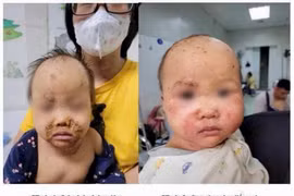 Bé gái 10 tháng tuổi bị viêm kết mạc do dị ứng thuốc nặng