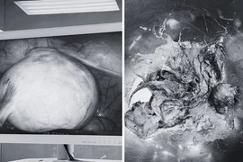 Loại bỏ u quái buồng trứng chứa đầy tóc, xương cho người phụ nữ mãn kinh