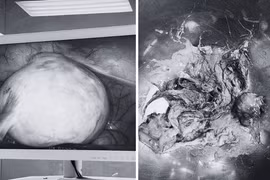 Loại bỏ u quái buồng trứng chứa đầy tóc, xương cho người phụ nữ mãn kinh