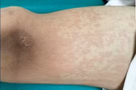 Chàng trai 17 tuổi phải cấp cứu trong đêm vì ăn ve sầu