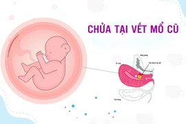 Vỡ thai chửa trên vết mổ cũ, sản phụ phải cắt tử cung