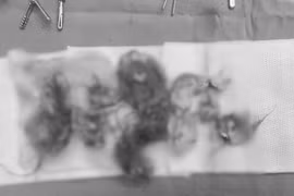 Tưởng đau bụng do rối loạn tiêu hóa không ngờ u quái buồng trứng