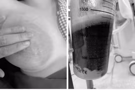 Sản phụ 18 tuổi áp xe vú phức tạp phải can thiệp ngoại khoa