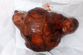 Diễn tiến âm thầm, phát hiện u thận đã nặng 1,2kg