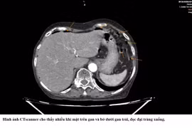 Liên tiếp ca thủng tạng nặng, cảnh báo nguy cơ bỏ sót triệu chứng ban đầu