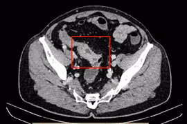 Cứu sống Việt kiều Mỹ bị bán tắc ruột do khối u đại tràng