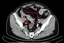 Cứu sống Việt kiều Mỹ bị bán tắc ruột do khối u đại tràng