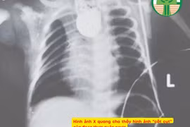 Teo thực quản bẩm sinh thường kèm dị tật tim, tiêu hóa