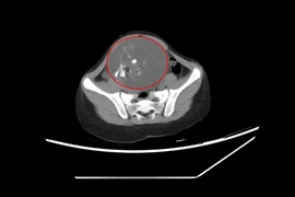 Bị táo bón bé gái 6 tuổi không ngờ mang u quái buồng trứng 