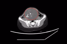 Bị táo bón bé gái 6 tuổi không ngờ mang u quái buồng trứng 
