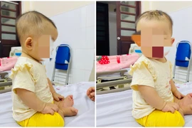 1 tuần sau ngã giường bé 7 tháng tuổi nguy kịch vì máu tụ