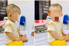1 tuần sau ngã giường bé 7 tháng tuổi nguy kịch vì máu tụ