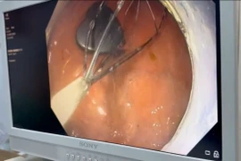 Nuốt phải dị vật nam châm dễ thủng ruột hoại tử