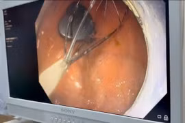 Nuốt phải dị vật nam châm dễ thủng ruột hoại tử