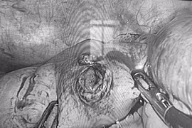 Cấp cứu thành công cho nam bệnh nhân bị đinh xuyên thủng ruột non