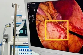 Bảo tồn lách cắt u thân – đuôi tụy giúp bệnh nhân phục hồi tốt