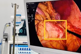 Bảo tồn lách cắt u thân – đuôi tụy giúp bệnh nhân phục hồi tốt