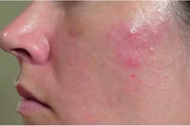 Chăm sóc đúng cách giúp kiểm soát viêm da tiết bã 