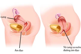 Phát hiện sa sinh dục độ III từ cảm giác tức vùng kín, phải cắt tử cung