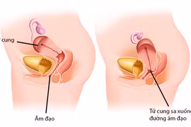 Phát hiện sa sinh dục độ III từ cảm giác tức vùng kín, phải cắt tử cung