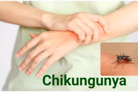 Nguy cơ Chikunguny xâm nhập vào Việt Nam, bác sĩ mách cách phát hiện sớm