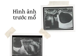 Cơn đau bụng bất thường không ngờ xoắn vòi tử cung hiếm gặp