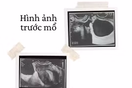 Cơn đau bụng bất thường không ngờ xoắn vòi tử cung hiếm gặp