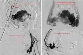Nút mạch điều trị chảy máu tử cung do thông động tĩnh mạch hiếm gặp