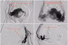 Nút mạch điều trị chảy máu tử cung do thông động tĩnh mạch hiếm gặp