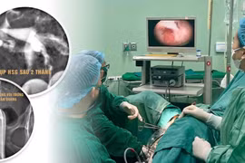 Vô kinh kéo dài suốt 6 tháng sau nạo hút thai do dính buồng tử cung