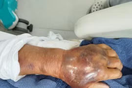 Chủ quan vết tôn cứa nhẹ người đàn ông nguy kịch vì vi khuẩn “ăn thịt người”