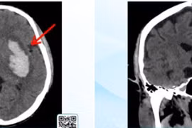 Hành trình cấp cứu xuất huyết não từ hôn mê đến hồi sinh