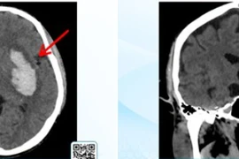 Hành trình cấp cứu xuất huyết não từ hôn mê đến hồi sinh