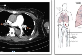 Giành lại sự sống cho người bệnh ngừng tim sau mổ u