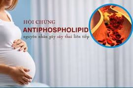 Sảy thai liên tiếp do hội chứng kháng phospholipid