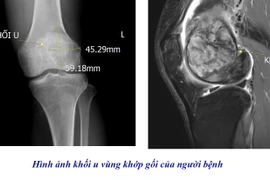 Đau khớp gối không đi lại được, tưởng bệnh xương khớp không ngờ u khổng lồ