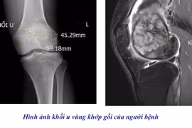 Đau khớp gối không đi lại được, tưởng bệnh xương khớp không ngờ u khổng lồ
