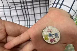 Đồng xu 2,5 cm mắc kẹt trong thực quản bé gái hơn 5 tuổi